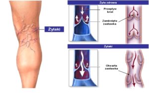 zylaki