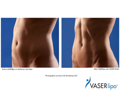 vaser lipo1
