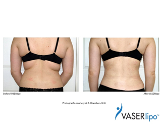 vaser lipo2