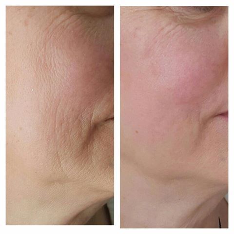 Ultraskin odmładzanie twarzy
