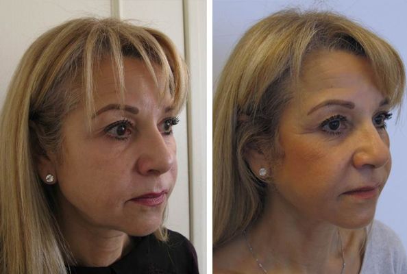 Ultraskin lifting twarzy efekty Ultraskin lifting twarzy efekty